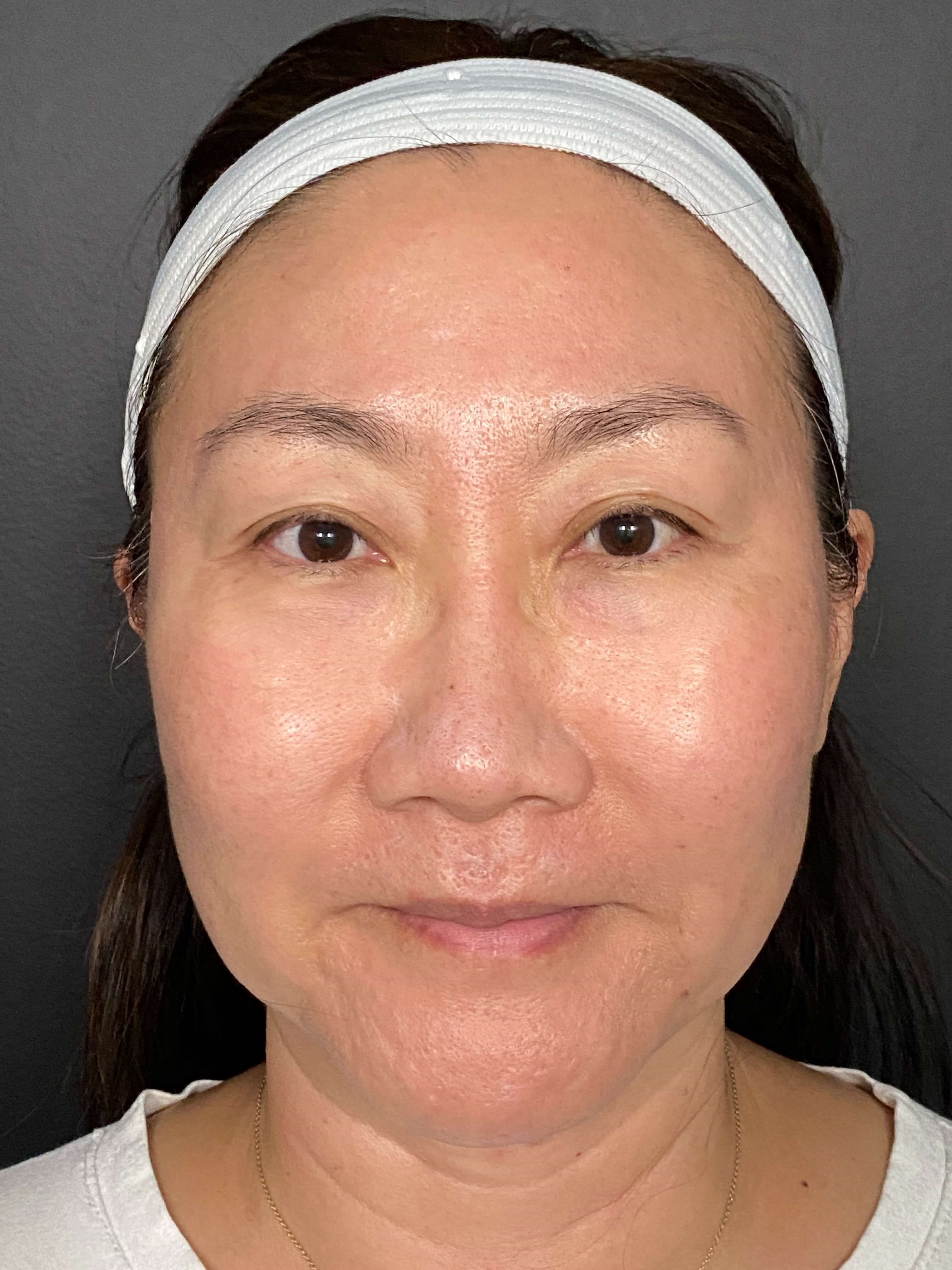 Front View After CO2 resurfacing + MNRF