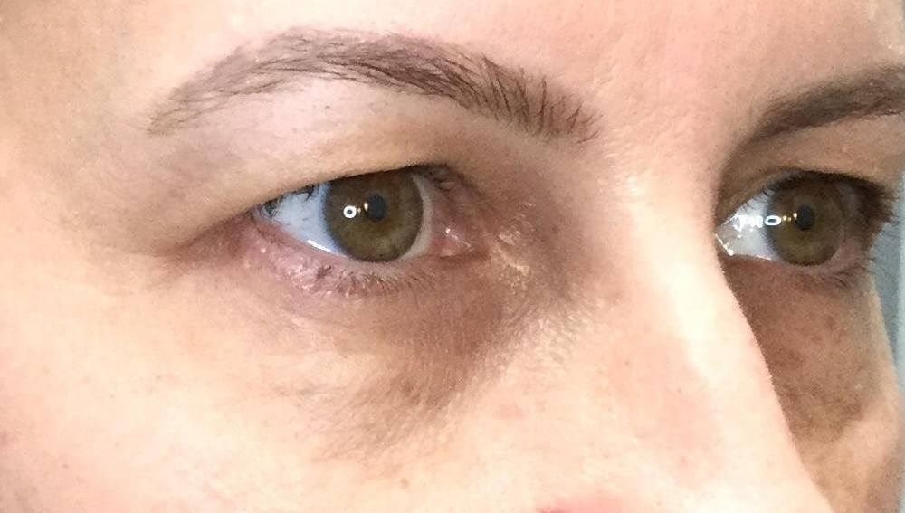 45 View Correction of dark circles