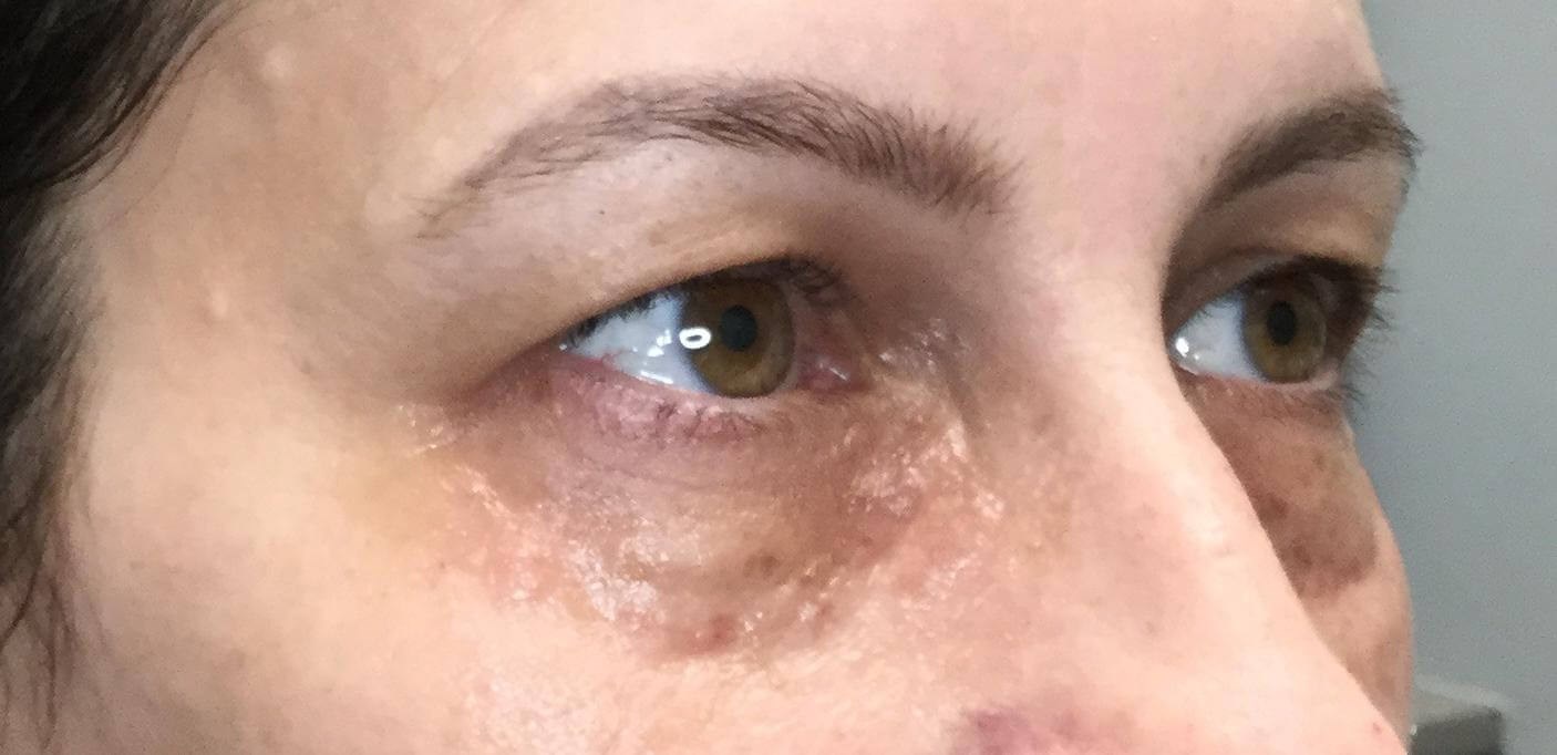 45 View Dark Circles before