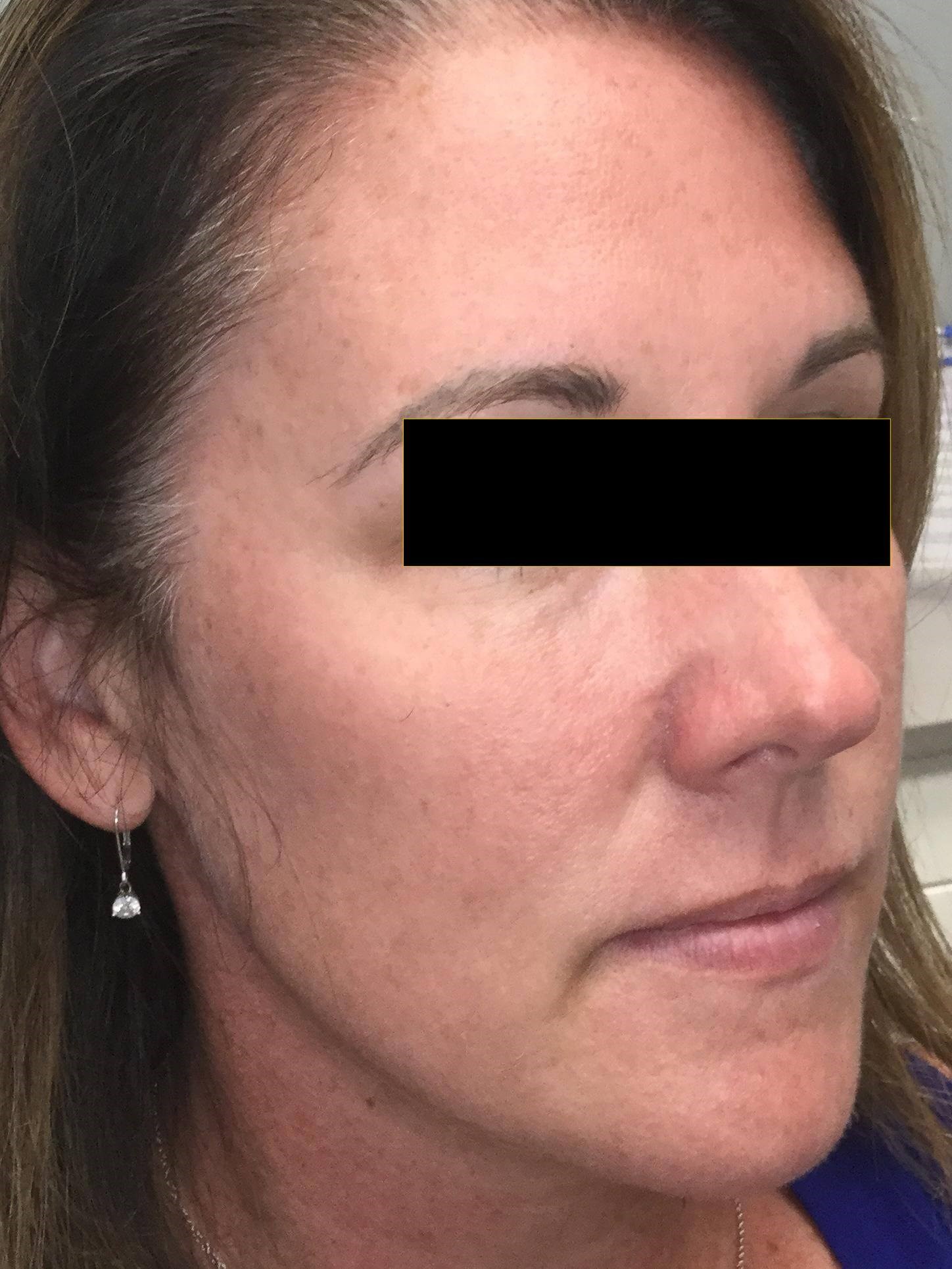From Beautiful to Stunning! Before Injectables and Laser