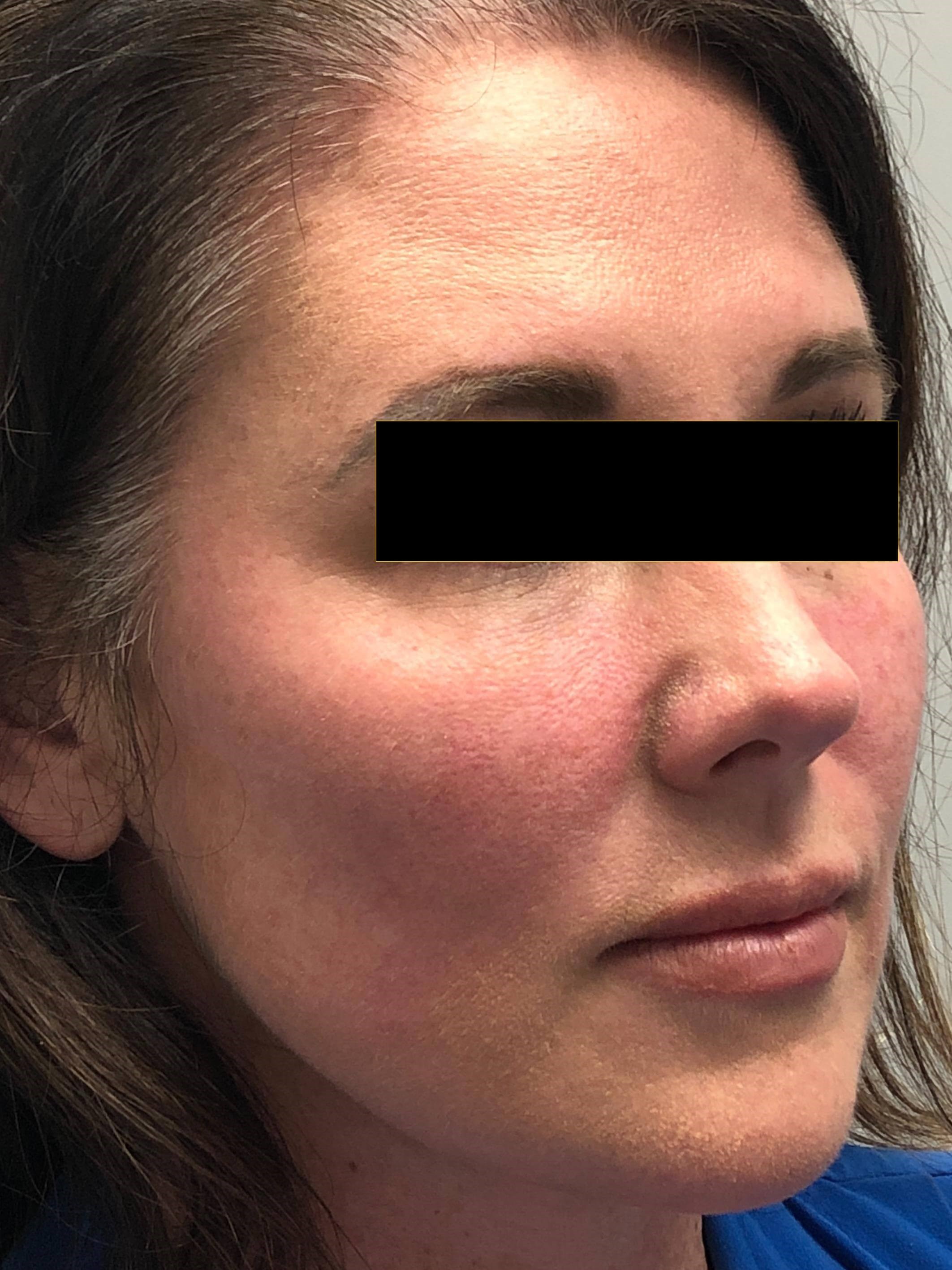 From Beautiful to Stunning! Before Injectables and Laser
