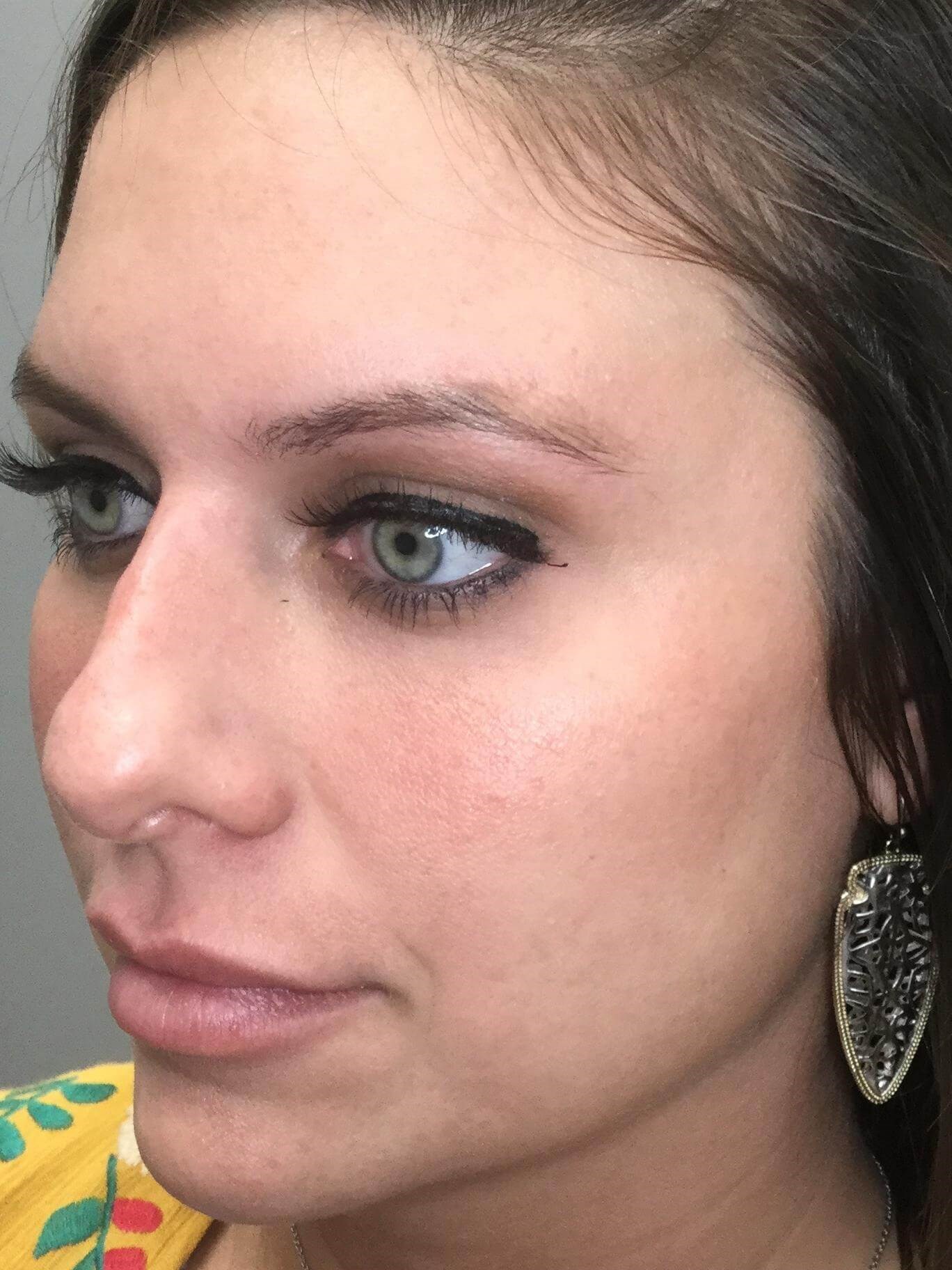 45 View After Cheek Filler
