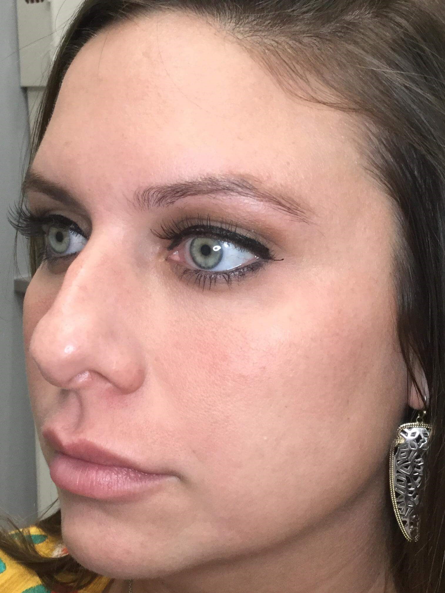 45 View Before Cheek Filler
