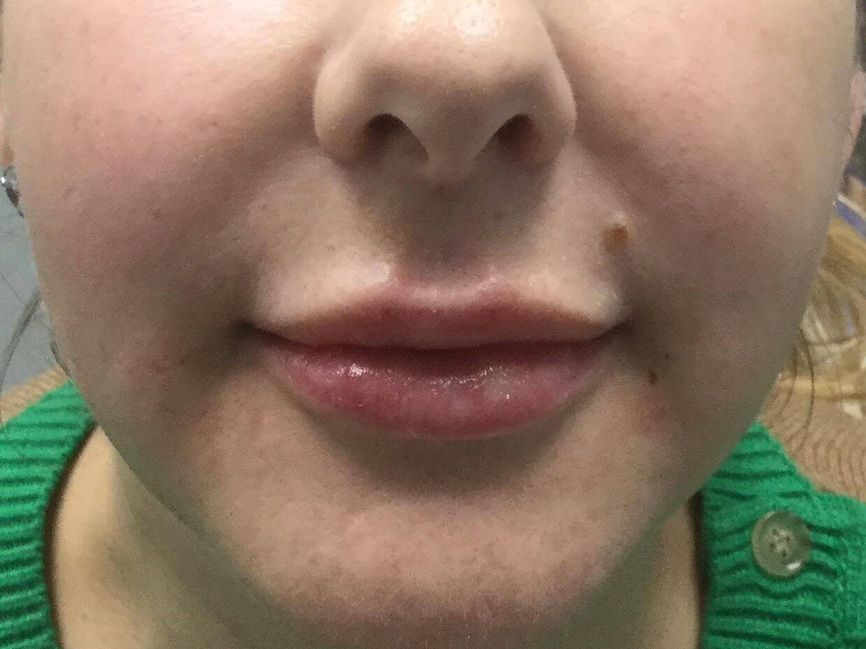 Lip Filler Enhancement After