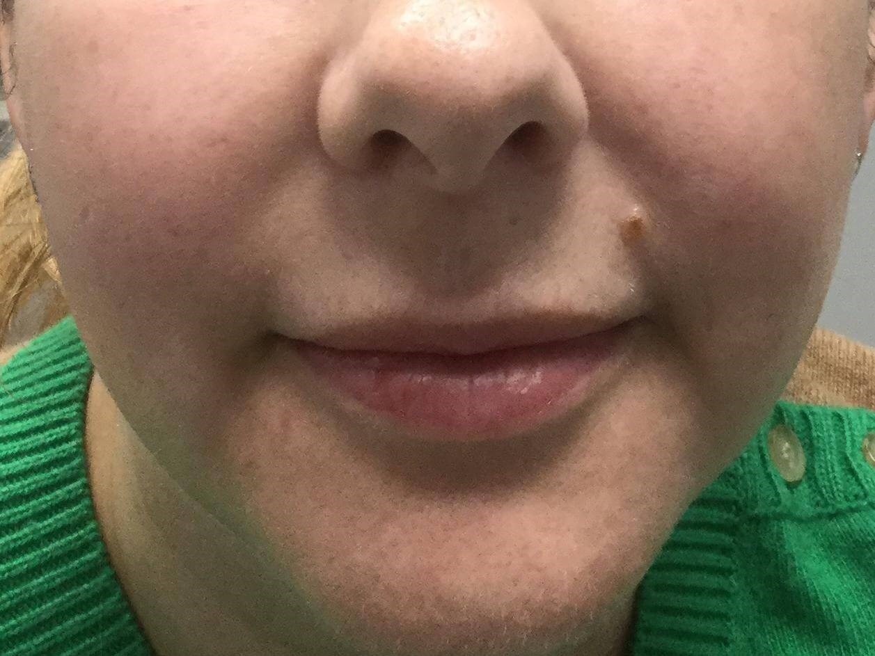 Lip Filler Enhancement Before