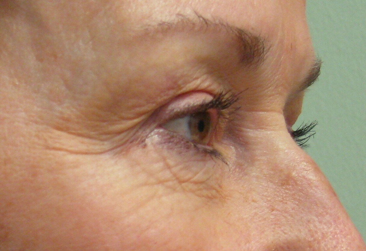 Non-surgical Laser Eye Lift Before Laser Eye Lift
