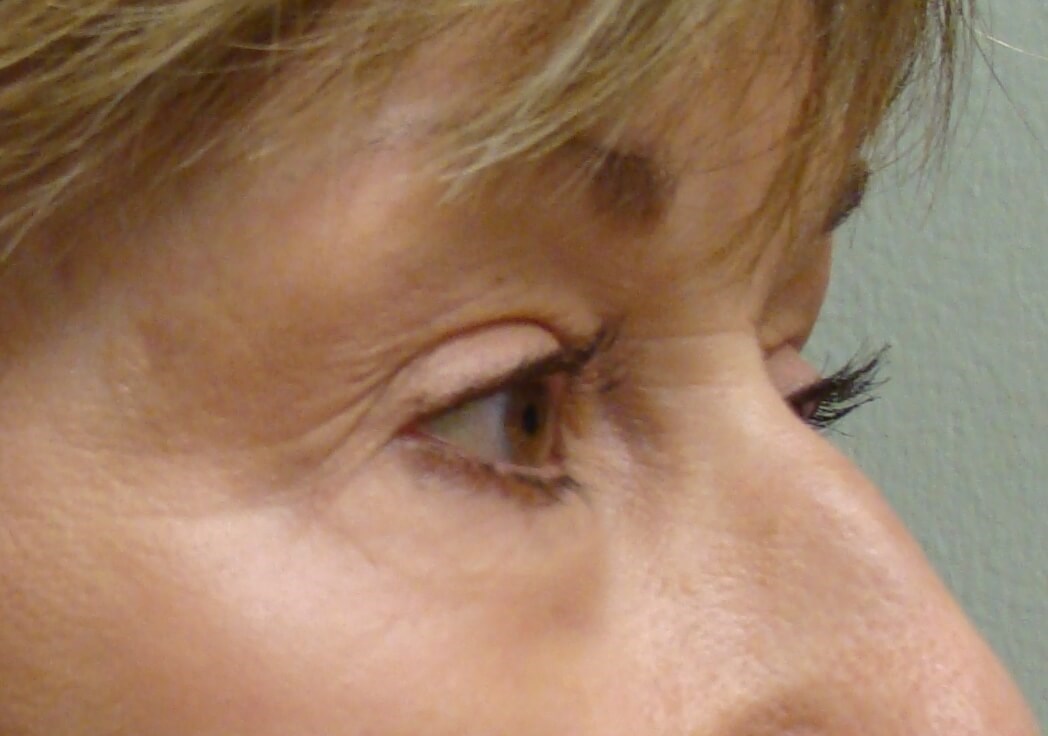 Non-surgical Laser Eye Lift After Laser Eye Lift