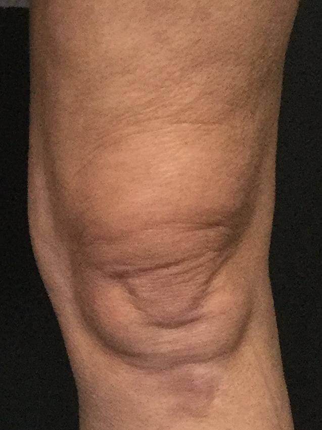 Front View After