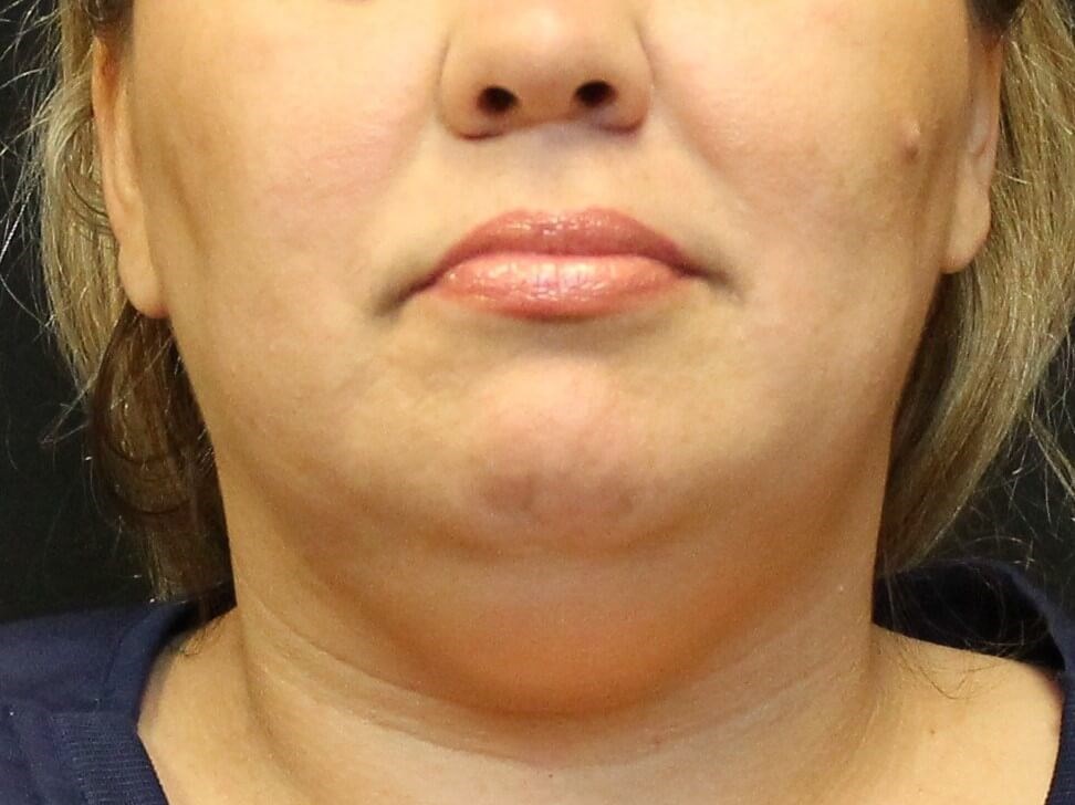 Front View After