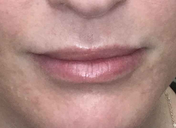Lip Enhancement with Juvederm Before