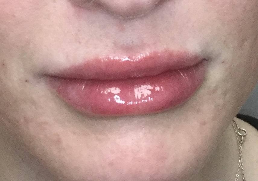 Lip Enhancement with Juvederm After