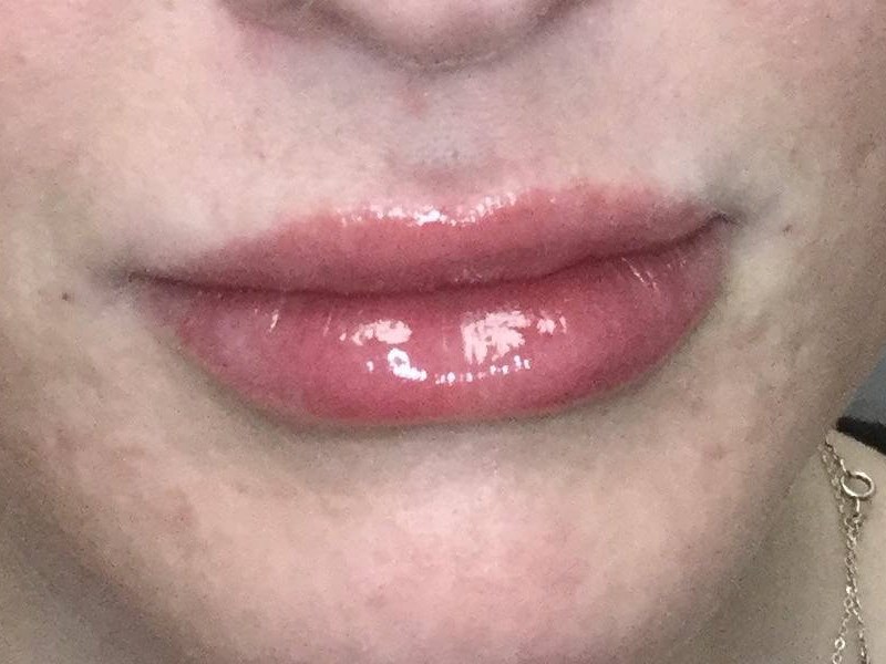 Lip Enhancement with Juvederm After