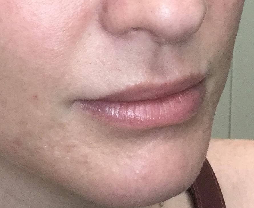 Lip Enhancement with Juvederm Before