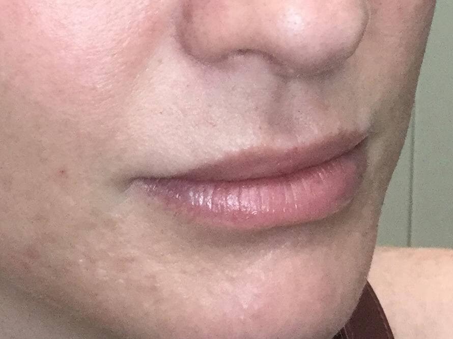 Lip Enhancement with Juvederm Before