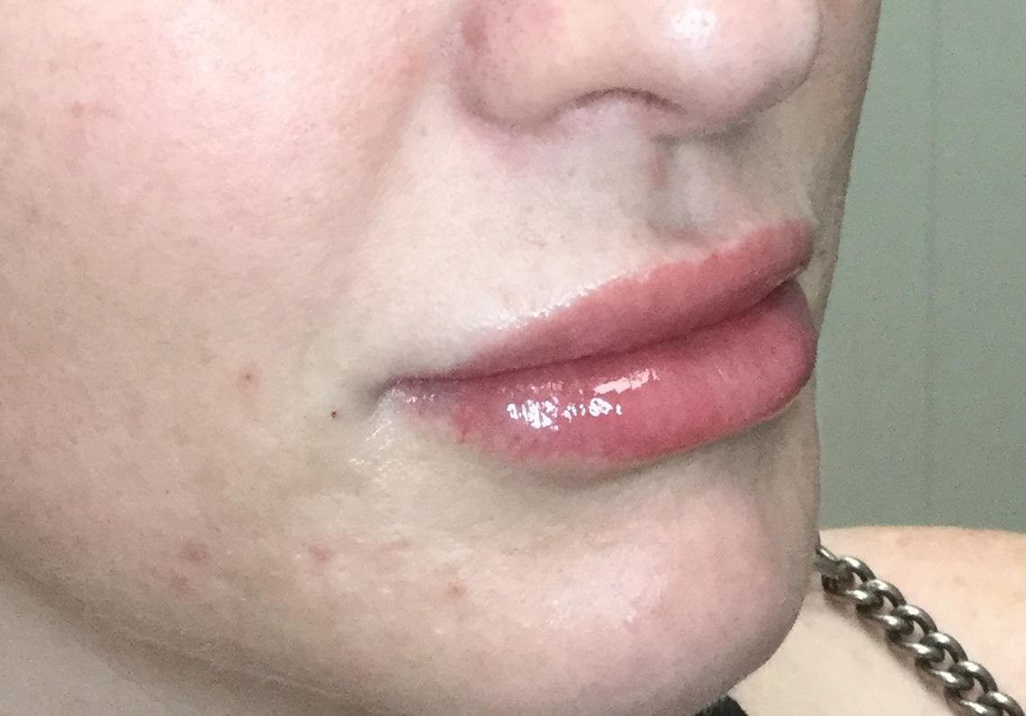 Lip Enhancement with Juvederm After