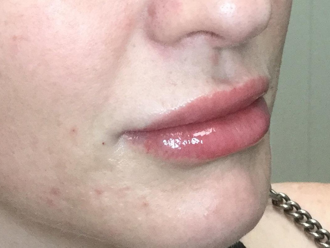 Lip Enhancement with Juvederm After