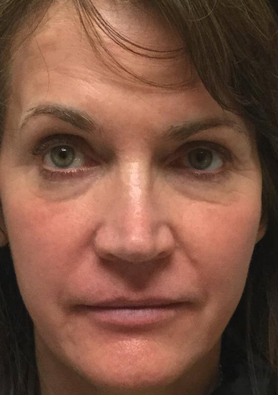 CO2 Fractional resurfacing After