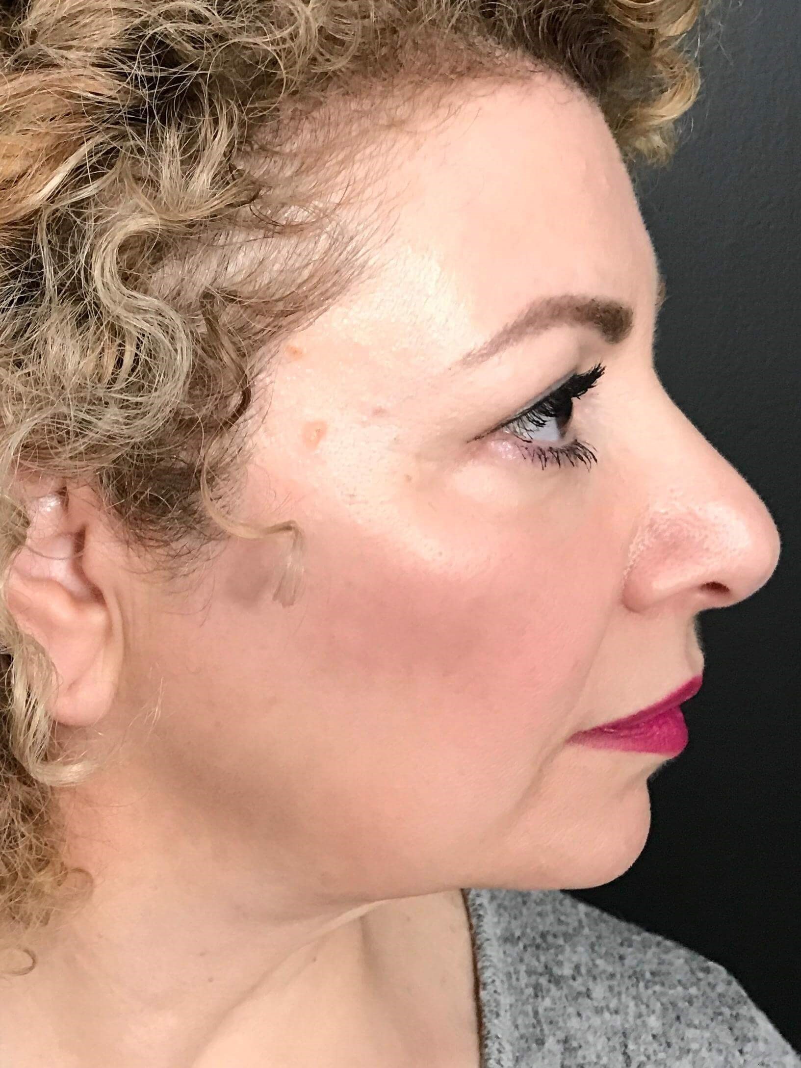 Profile View 8 Months After 2nd Treatment