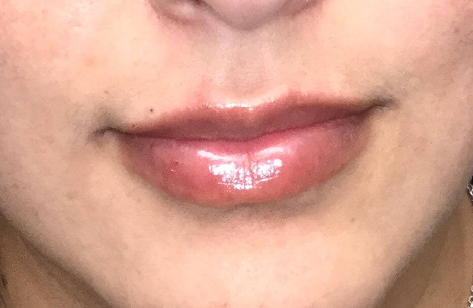 Lip Filler Augmentation After