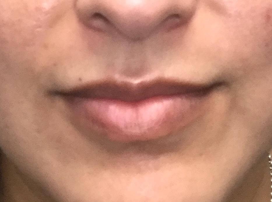 Lip Filler Augmentation Before