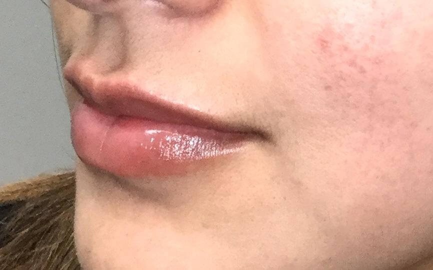 Lip Filler Augmentation After