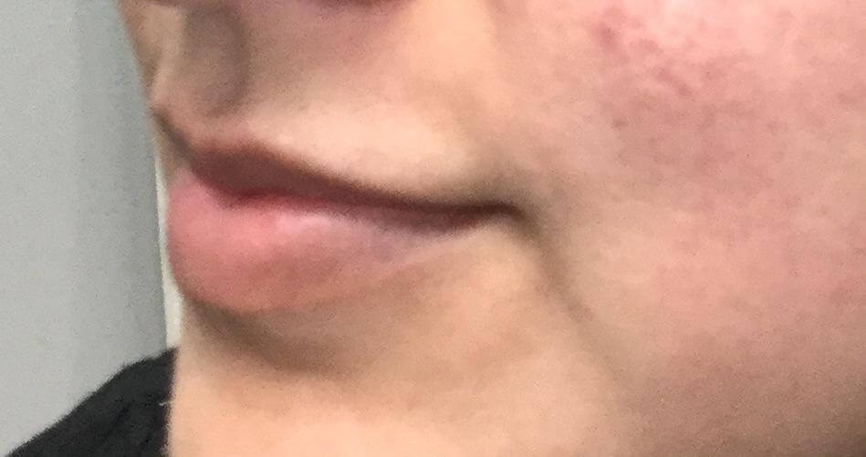 Lip Filler Augmentation Before