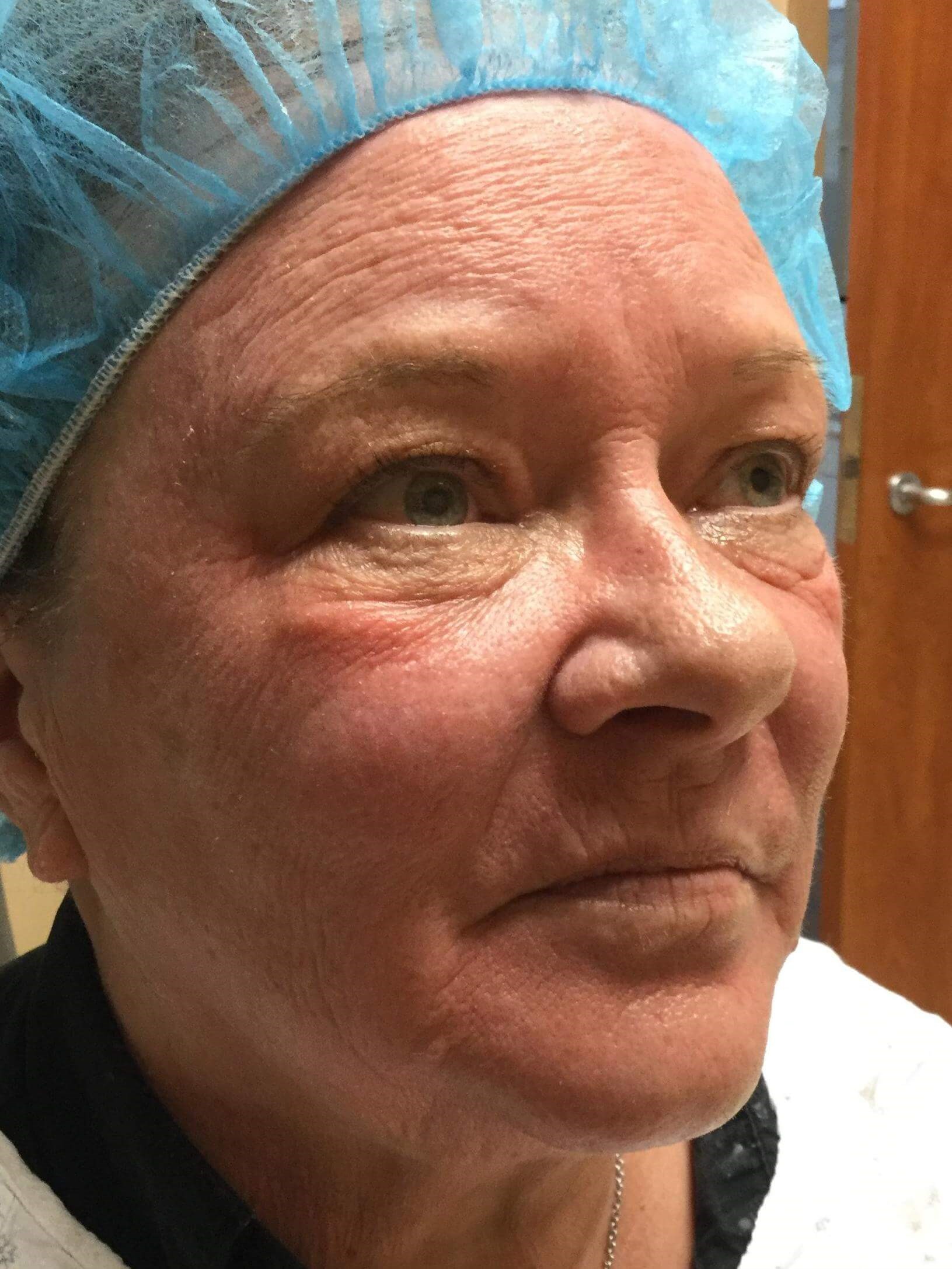 Fractional CO2 Resurfacing Before