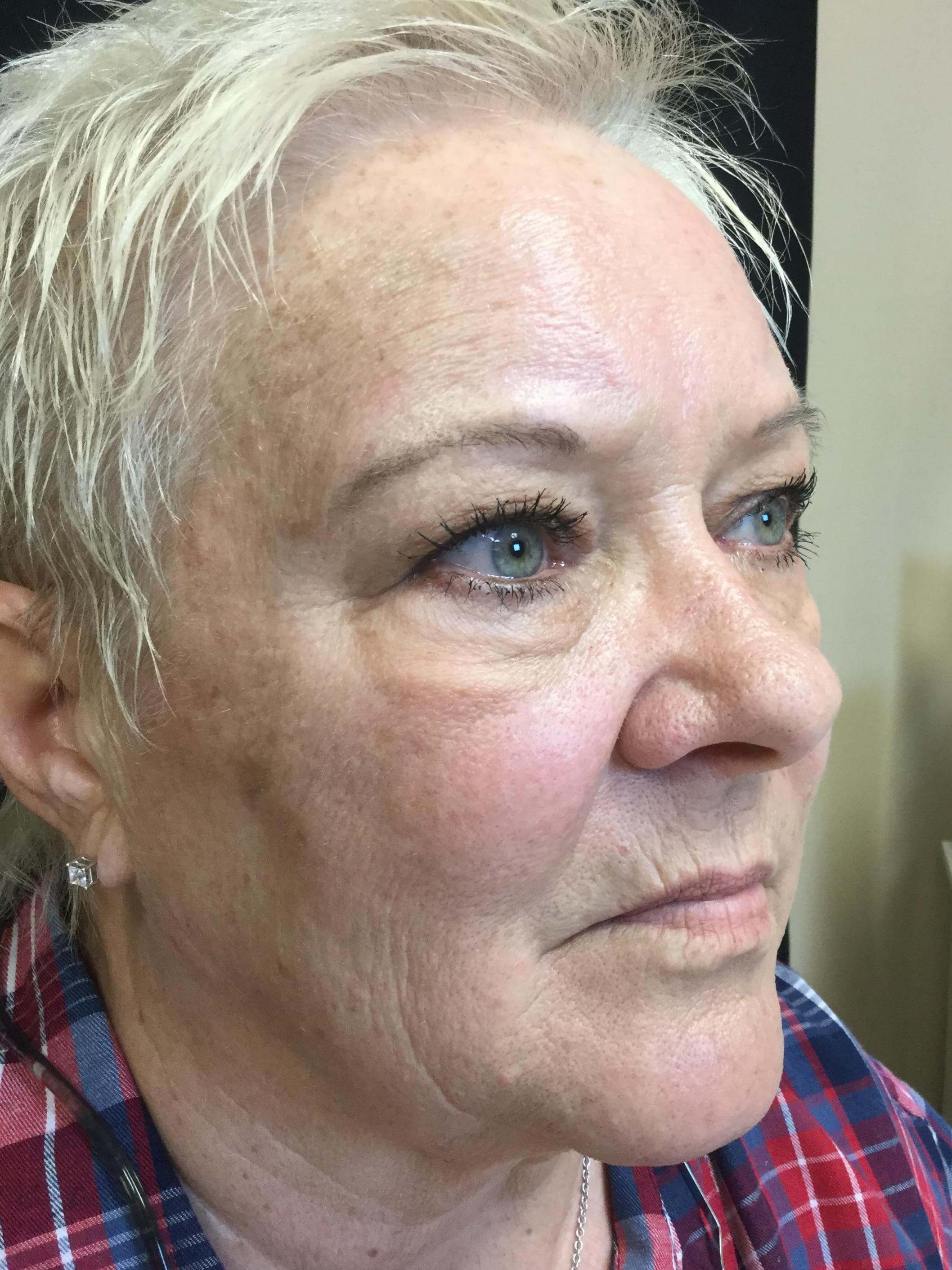 Fractional CO2 Resurfacing After