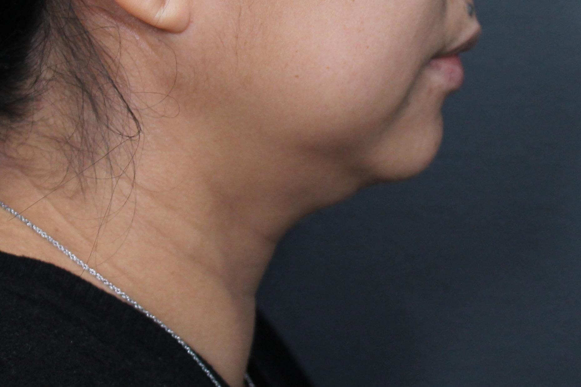 Profile View Before