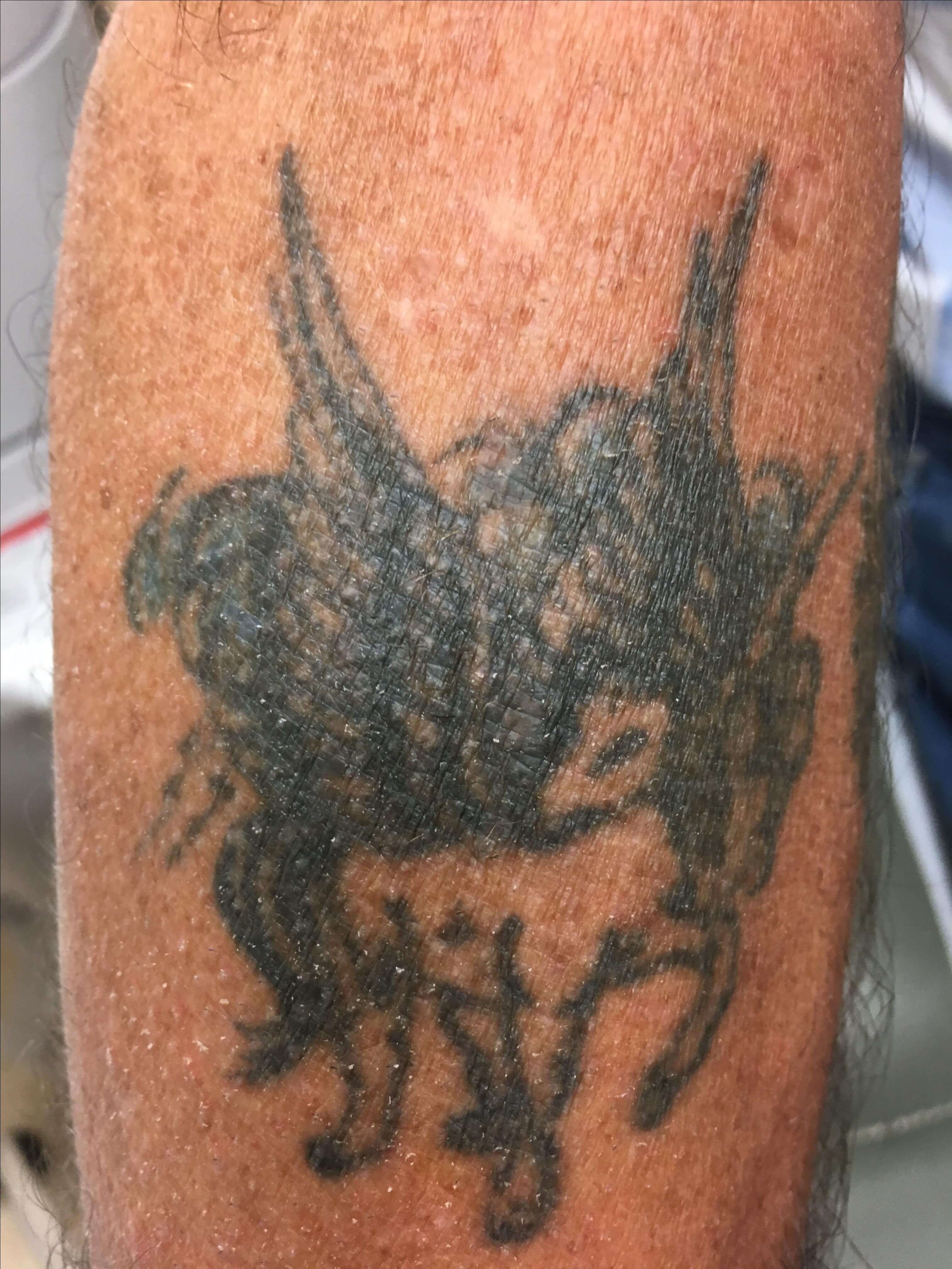 Unwanted Tattoo Removal Before