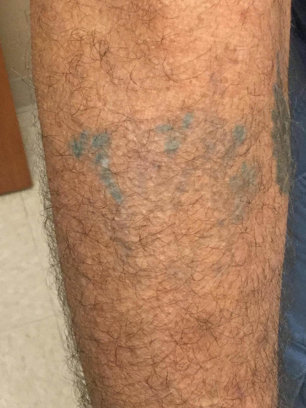Unwanted Tattoo Removal After