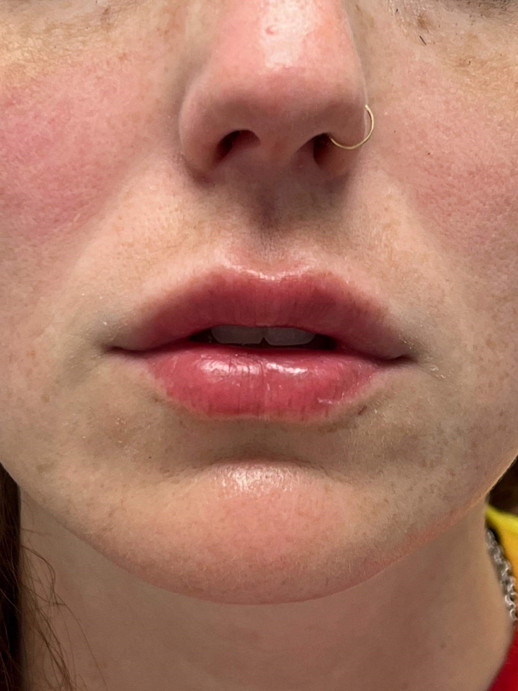 Front View After