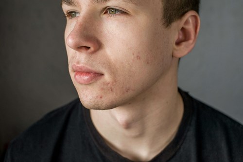 Acne Scars
