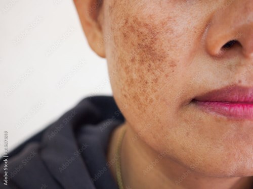 Age Spots