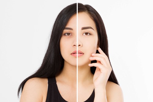 Dark Circles Around Eyes